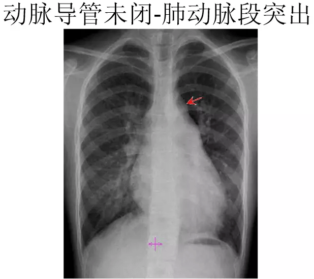 x线中的心影增大,你真的会看吗?