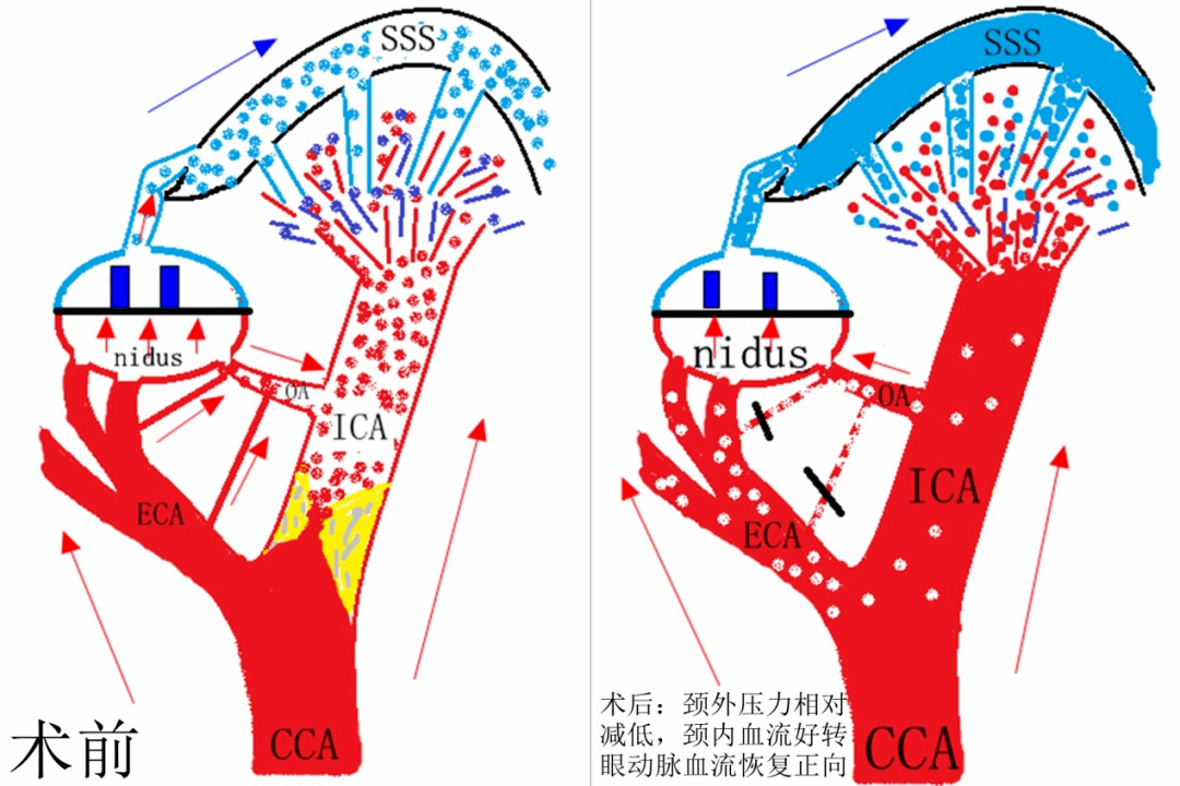 血流方向改变前后血流模式图