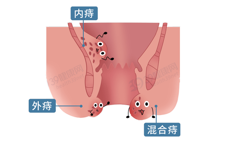 4个因素是脱肛"根源",不要忽视