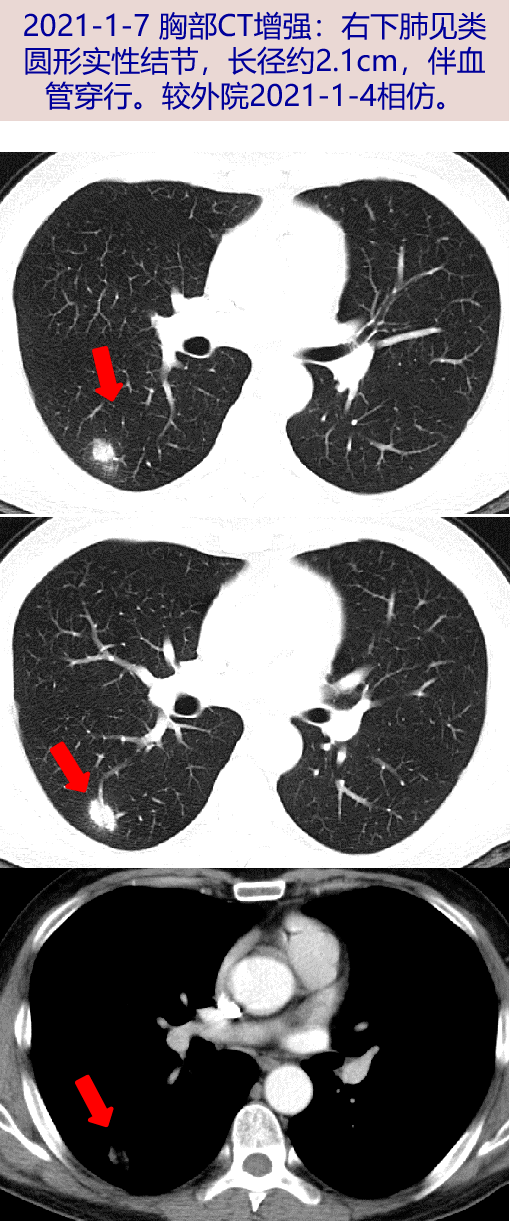 探案丨咳嗽咳痰肺结节,别的不怕,就怕得癌_病灶