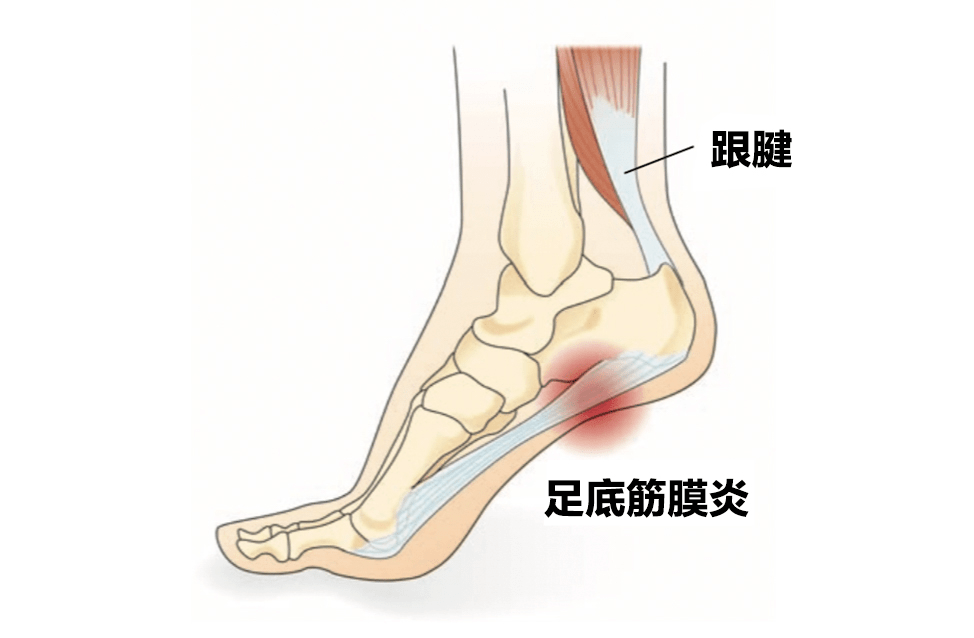 足病之足底筋膜炎