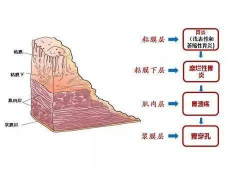 疾病科普丨医生糜烂性胃炎的4大危害3大病因