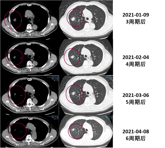 图1-4 治疗期间左肺结节动态变化