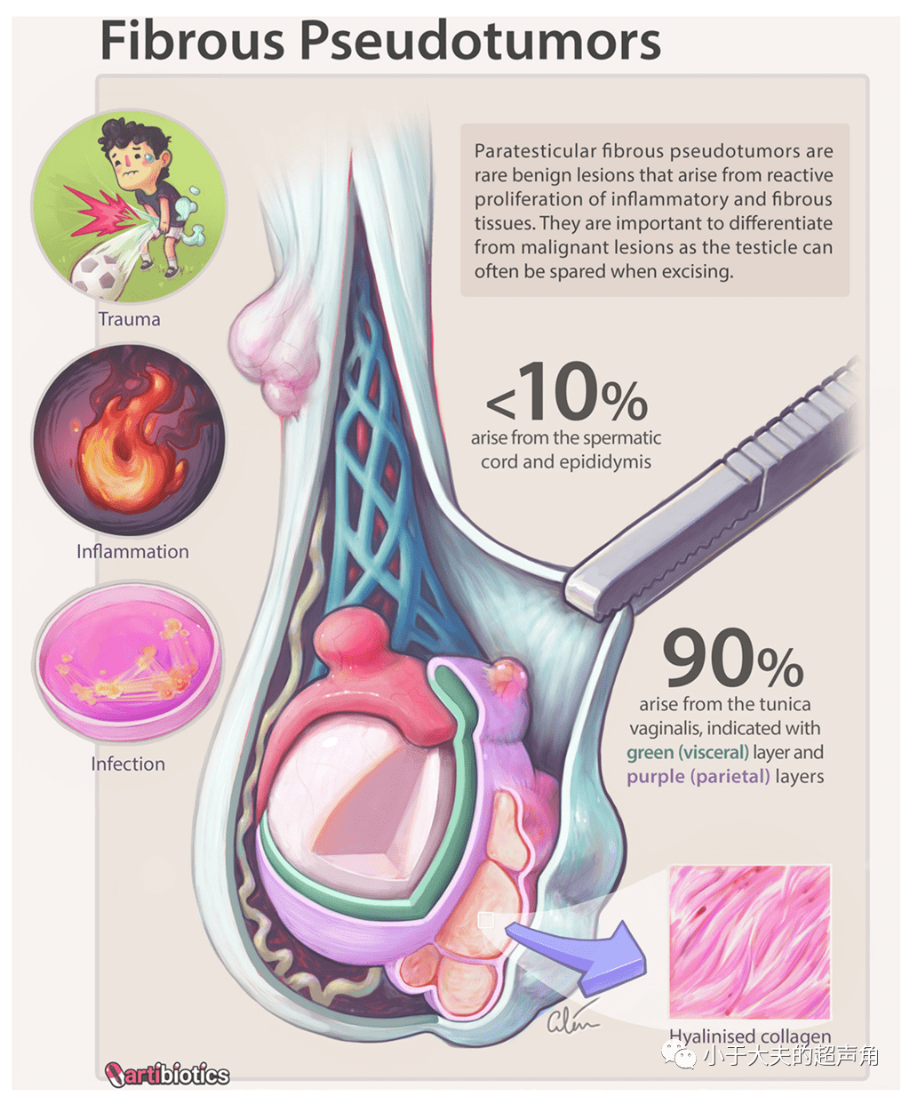 揭秘:〖纤维性假瘤〗 fibrous pseudotumor_睾丸