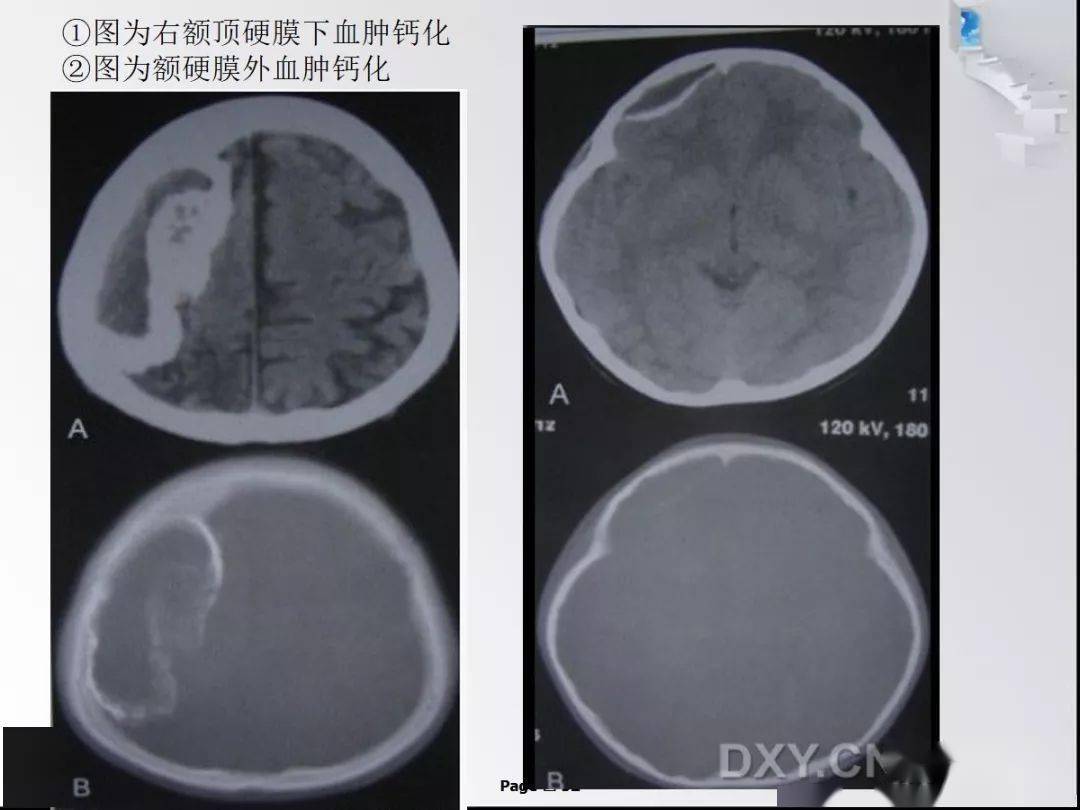 颅内钙化性病变