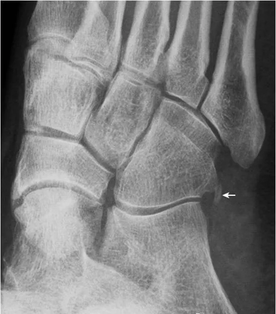 足部x线的正常表现与常见变异及病变,建议收藏