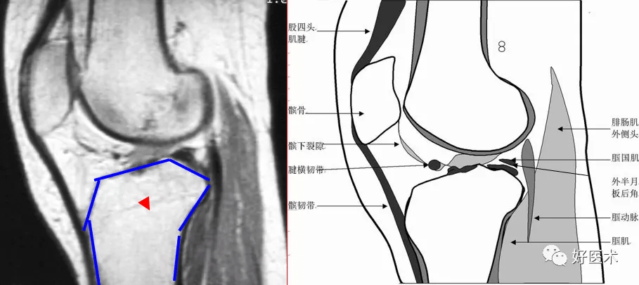 半月板解剖及损伤的详细图解