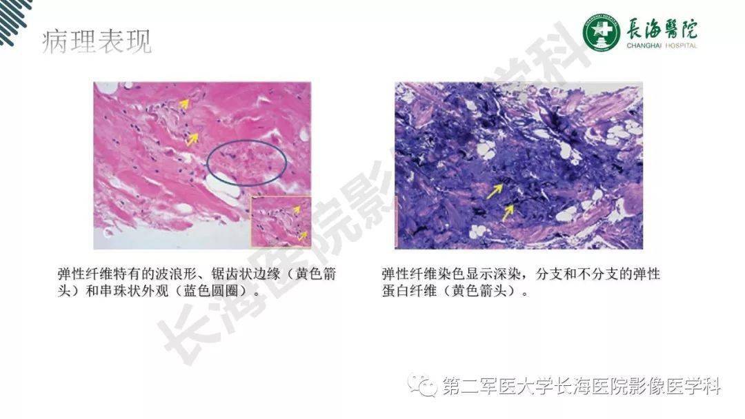 弹力纤维瘤的影像诊断