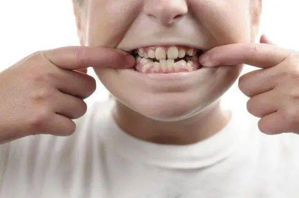 例 深 覆 牙 合,12 例 中 开 牙 合,24例下颌后缩,18例牙齿扭转错位