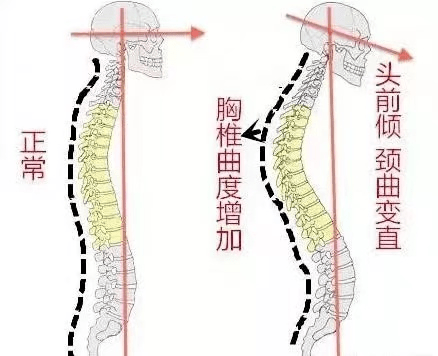 颈椎曲度由原本的正常曲度(下图左)变直后(下图右).你以为受伤的