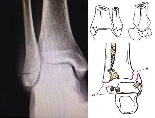i度 内踝骨折或三角韧带损伤(断裂 ii度 下