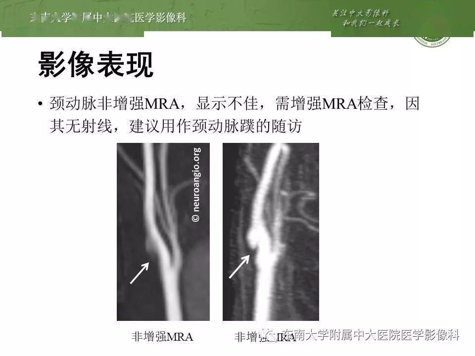 颈动脉蹼!千万不要以为是动脉夹层