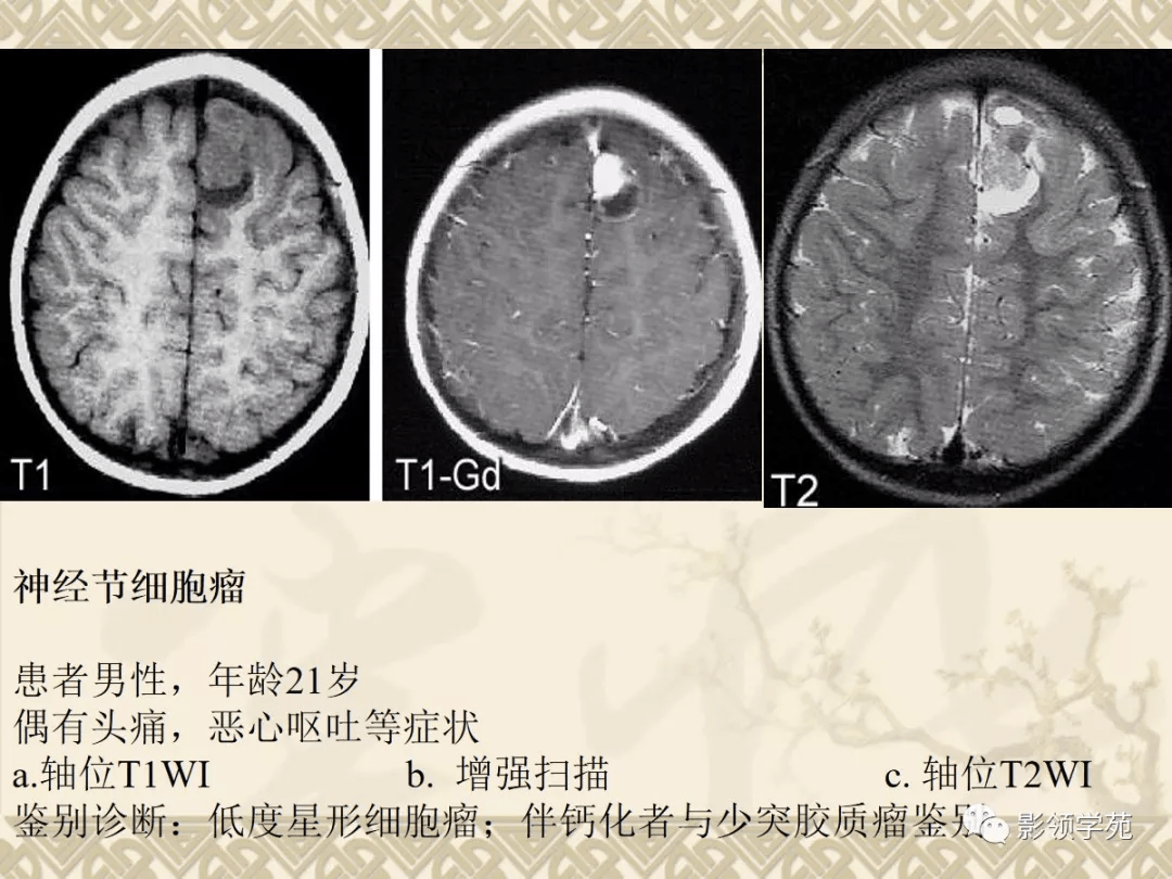 常见脑肿瘤的影像诊断