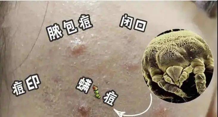 有97%的成年人皮肤上寄生有螨虫!而且有90%的痤疮起因也是螨虫!
