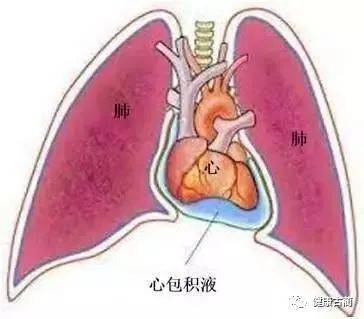 心包穿刺?好吓人!看看古蔺县人民医院心血管内科医师如何成功操作!