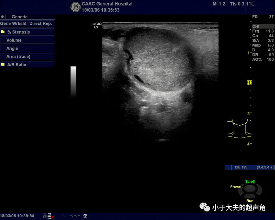 超声随响第79期腮腺基底细胞腺瘤basalcelladenoma