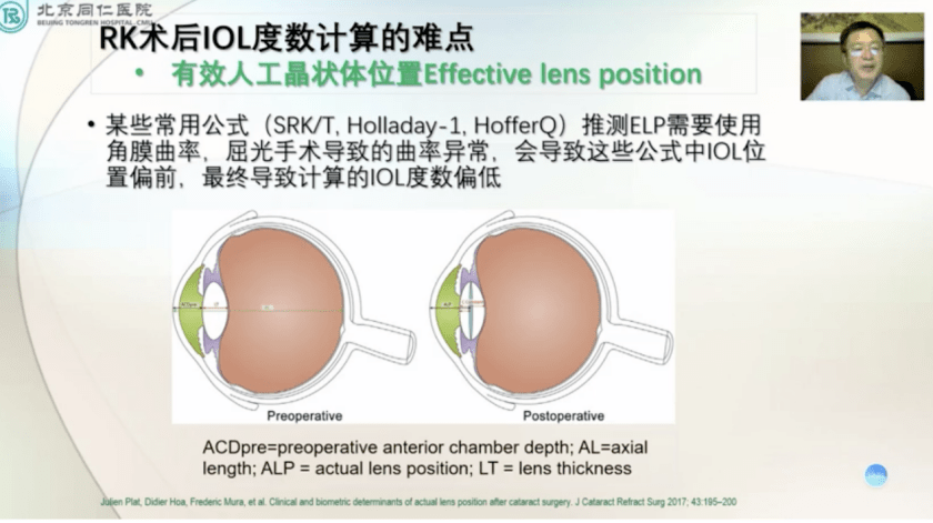 全程规划精准狙击丨宋旭东教授谈rk术后白内障手术的精准规划与管理