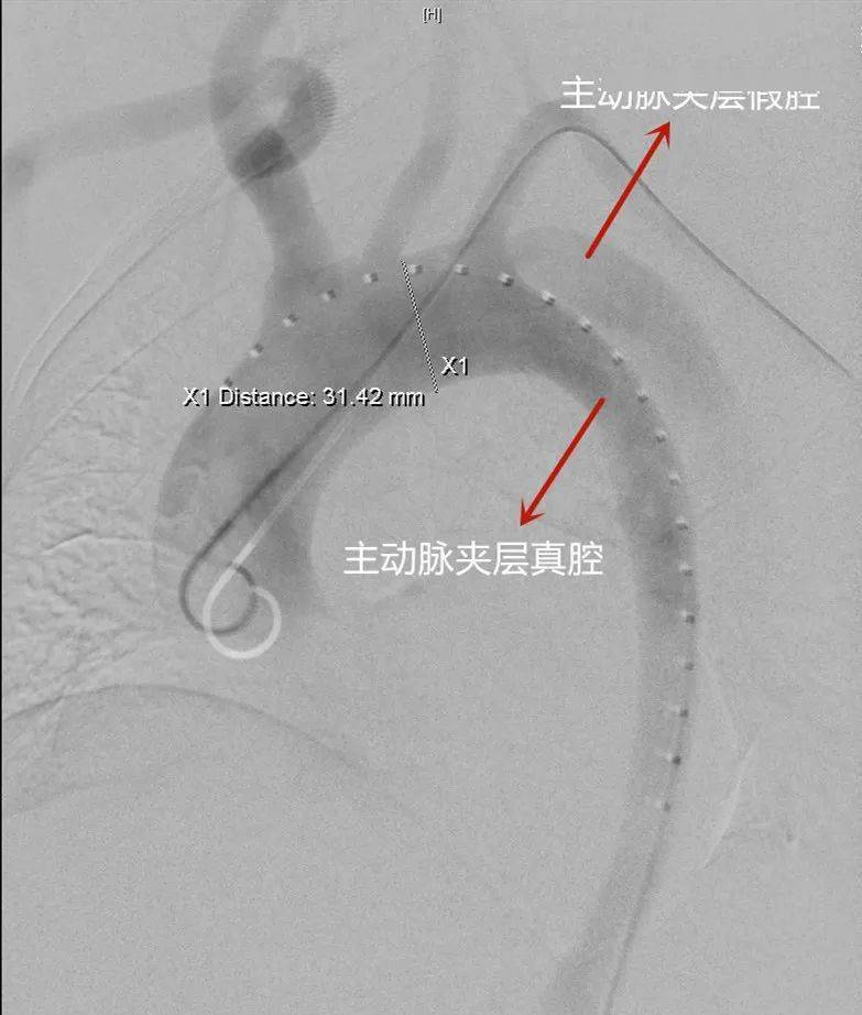 激光原位开窗术 清华长庚成功救治主动脉夹层患者