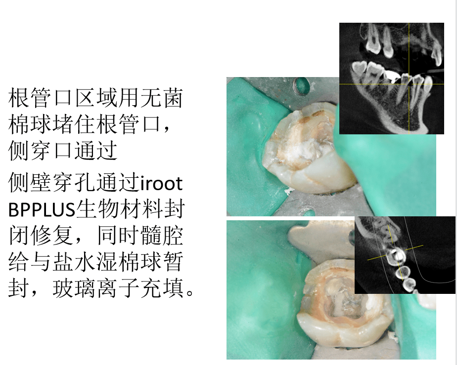 病例侧壁穿孔修补irootbpplus的应用