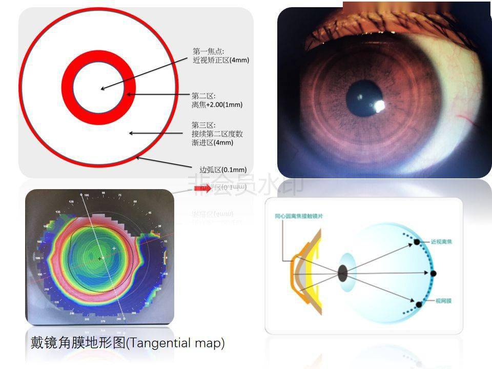 眼视光离焦软镜介绍