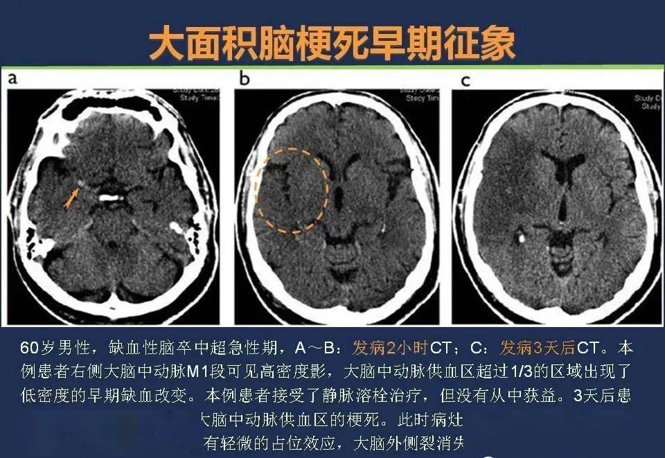 头颅ct如何预判超早期脑梗死?