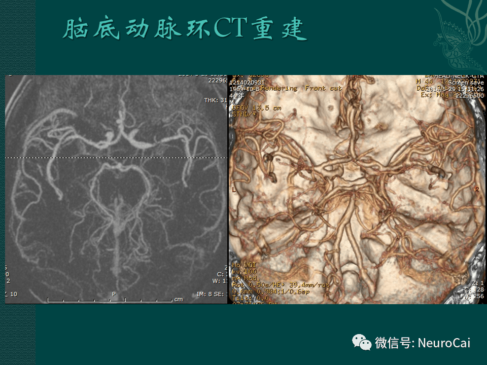 高清图:脑动脉解剖与ct重建