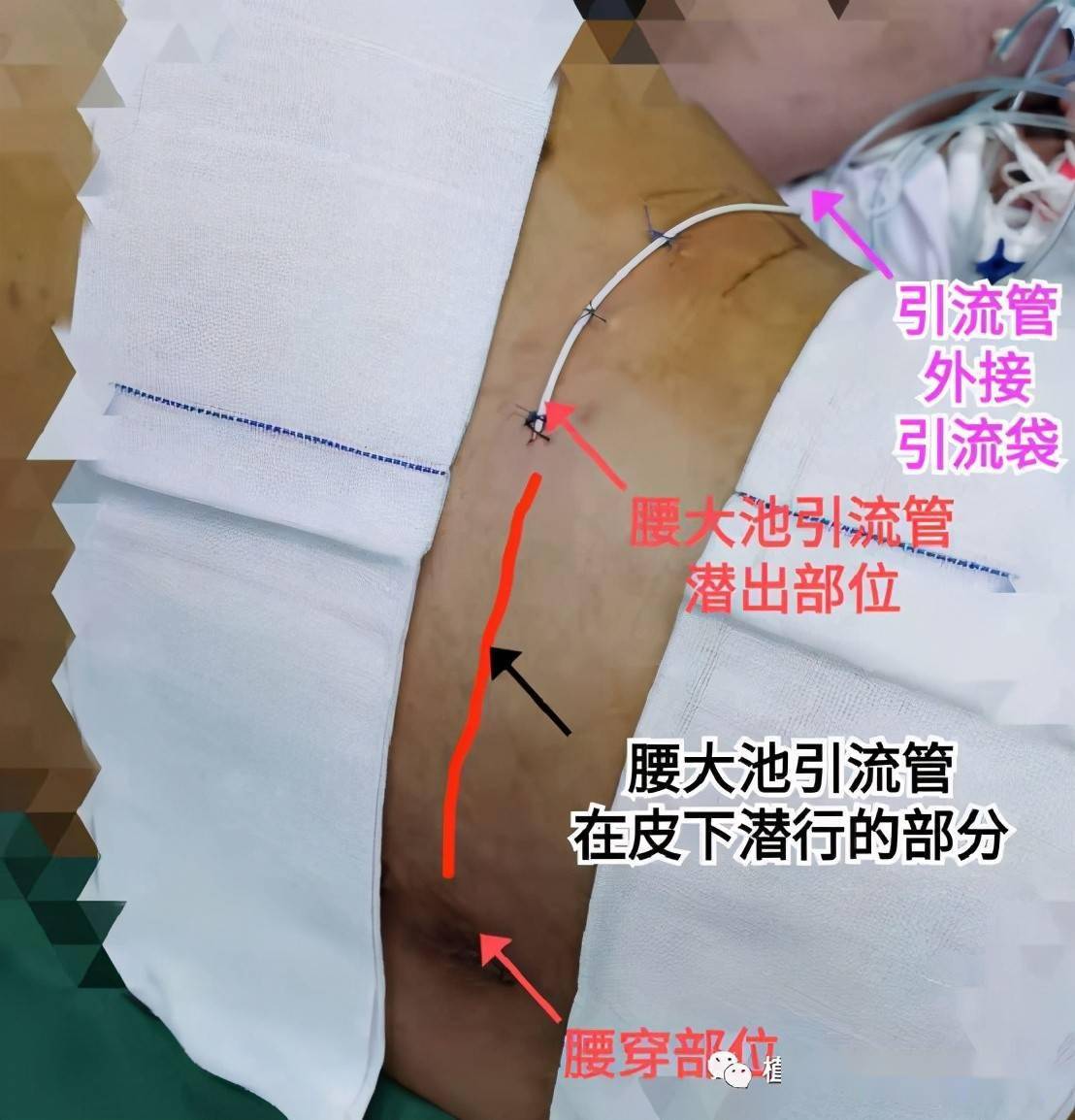 腰大池外引流装置,一面引流脑脊液,一面抗菌进行治疗.