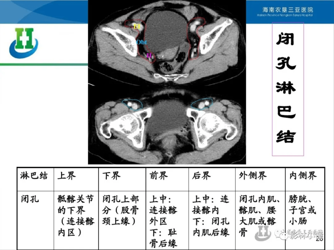 盆腔淋巴结的影像解剖及临床应用