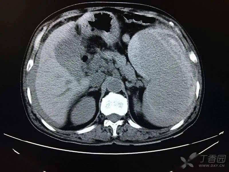 查上腹部 ct 示:脾大,脾破裂,腹腔积液,积血(图 5).