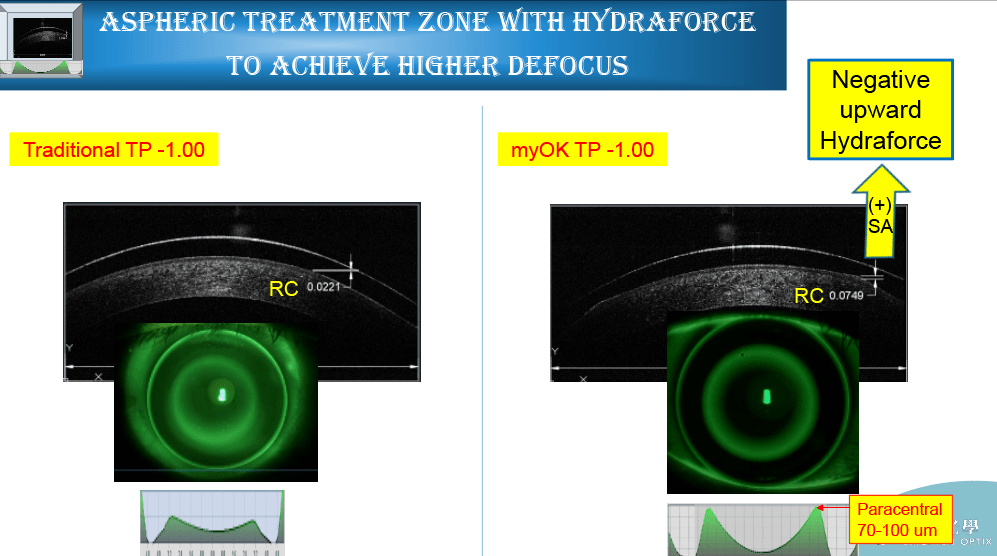 亨泰光学技术部myok03项目负责人钟宜蓉myok03角膜塑形镜的设计