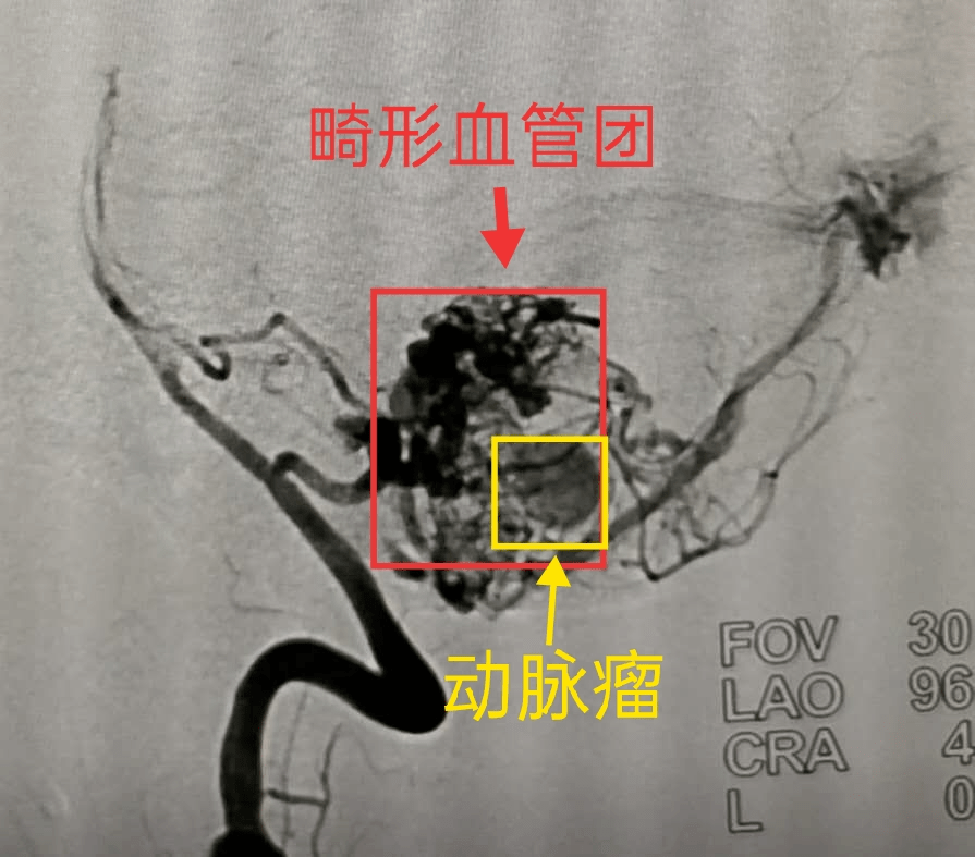 平度市第三人民医院外二科成功救治1例复杂动静脉畸形