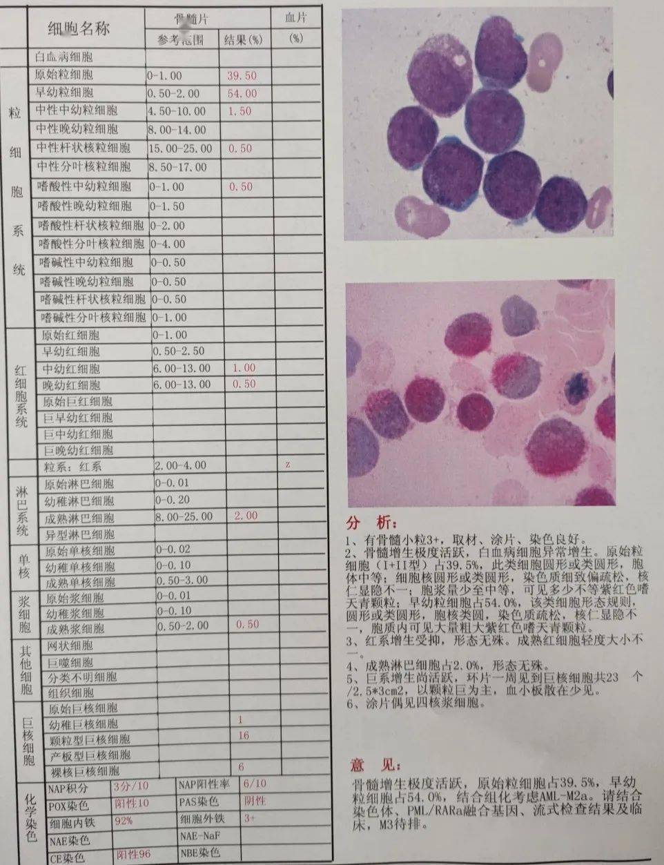 骨髓报告