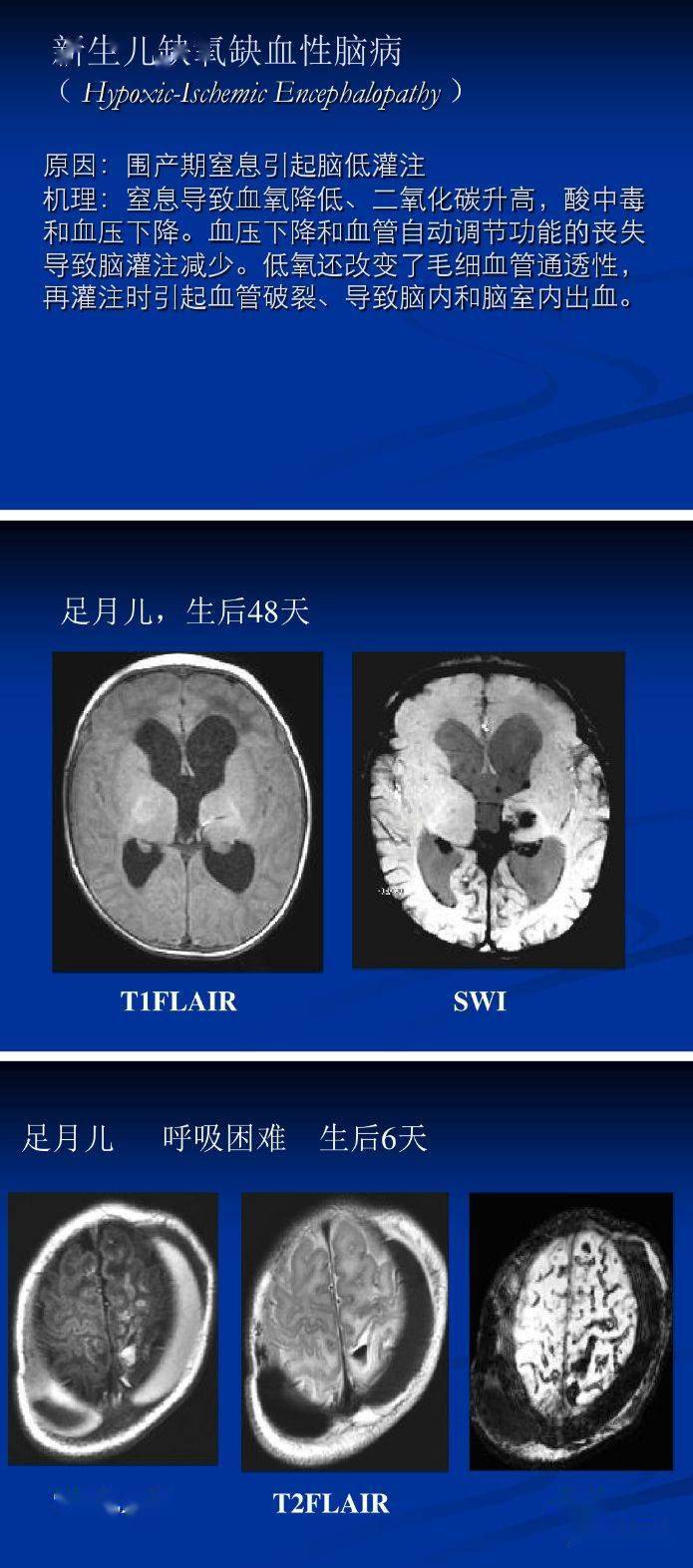 磁敏感加权成像(swi)详细临床应用_解剖图