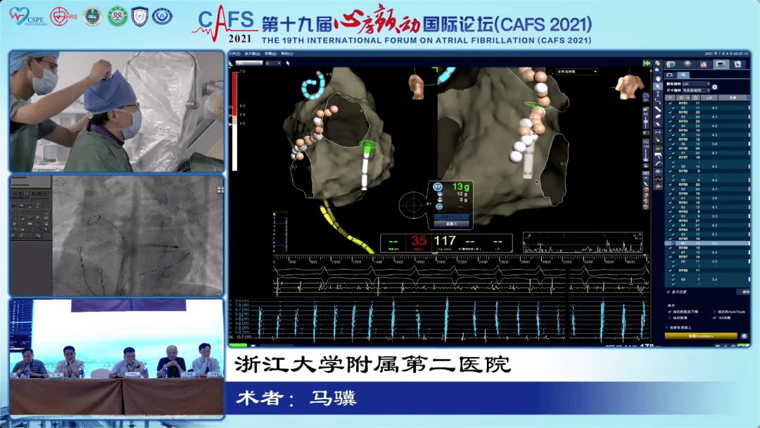 cafs 2021 | 大咖云集·共话消融 房颤手术演示专场邀