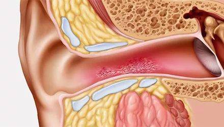 急性中耳炎导致的耳膜穿孔