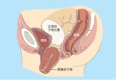 一,盆底脏器脱垂(子宫脱垂,阴道前/后壁膨出) 常有中老年人是因发现