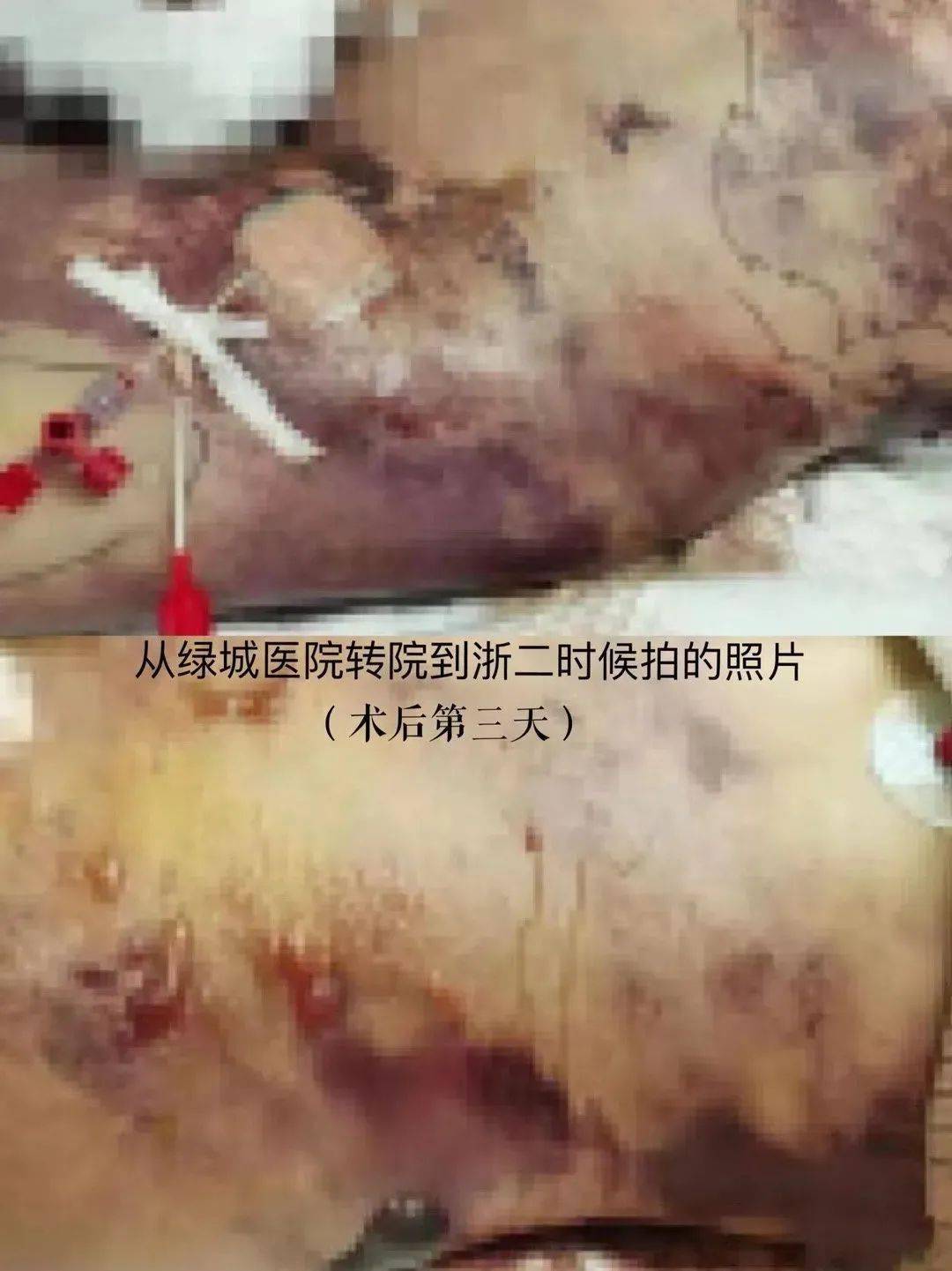 33岁女网红抽脂丰胸去世!生前照片曝光,惨不忍睹!容貌