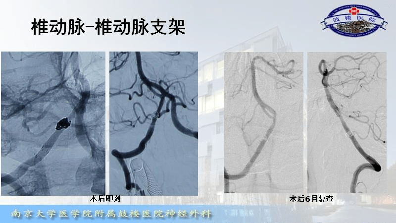 神介骑士论坛第12期精华回顾出血性椎动脉夹层动脉瘤的介入治疗