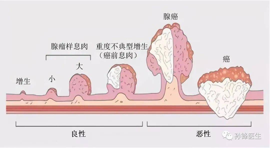 在大肠息肉中,有些是非肿瘤性息肉:比如炎症性息肉,增生性息肉,错构