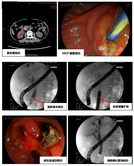 ercp 胆总管结石取出术