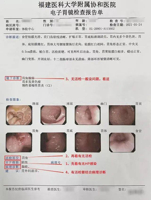 胃镜报告单实拍 供图:福建医科大学附属协和医院胃外科1,先看有没有