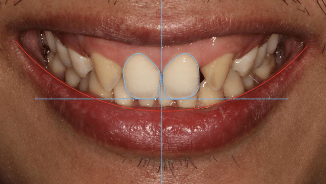 面像分析:曈孔线与切缘线平行,上中切牙中线与面部中线重合