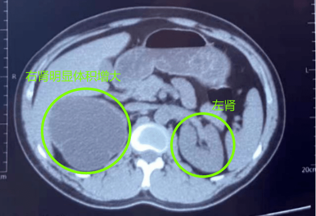 真相 肾结石,不痛就不需治疗吗?