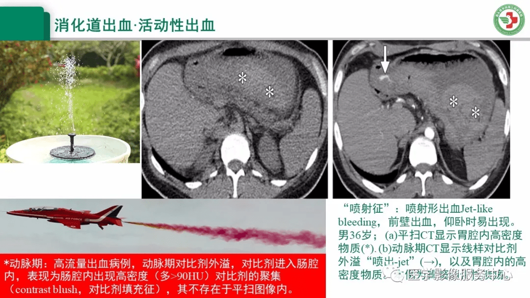 上消化道出血的ct诊断