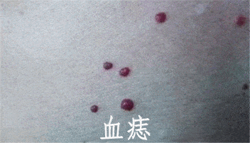 信号1:血痣,黑痣,蜘蛛痣 信号3:鼻头红,眼睛红,手掌红