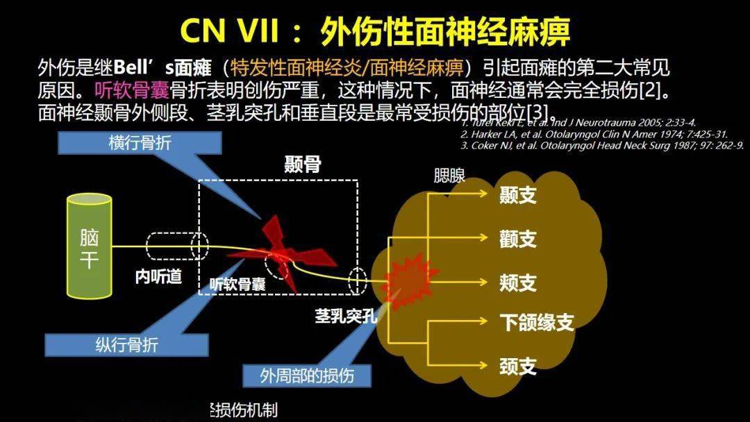 创伤性颅神经损伤的影像表现