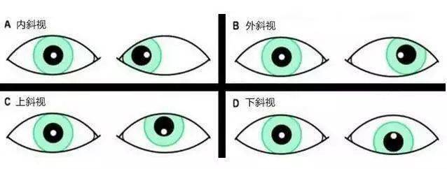 斜视治疗不及时,可能会耽误孩子一辈子!这不是危言耸听
