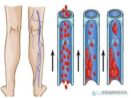 pe,是以各种栓子阻塞肺动静系统为其发病原因的一组疾病或临床综合症