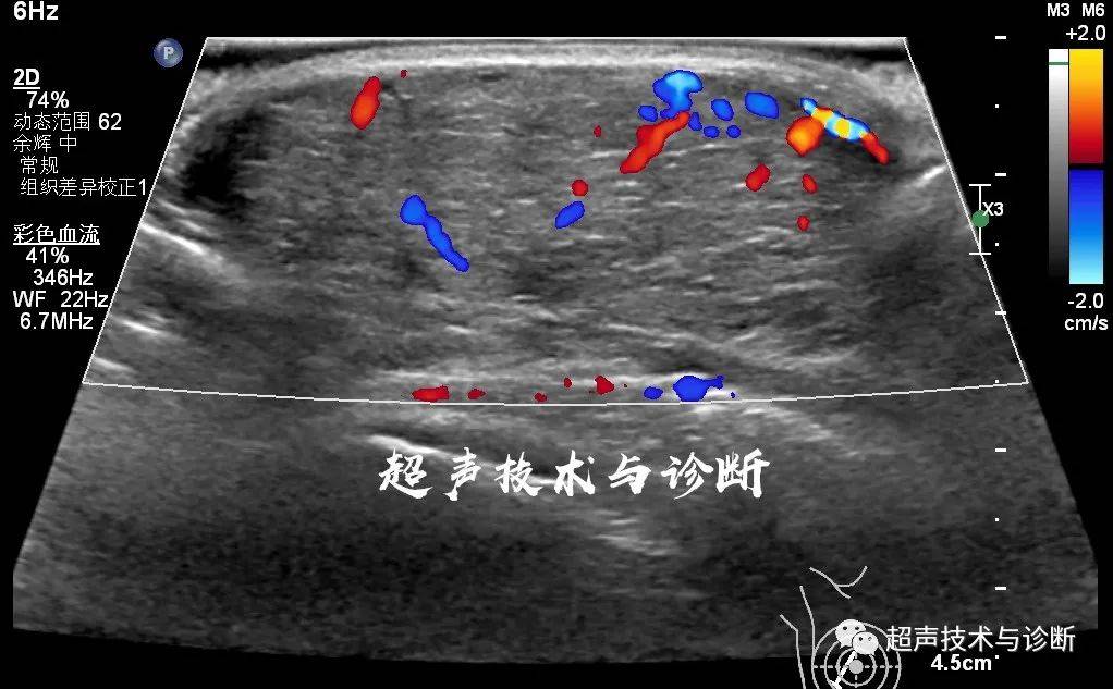 乳腺叶状肿瘤的超声表现.