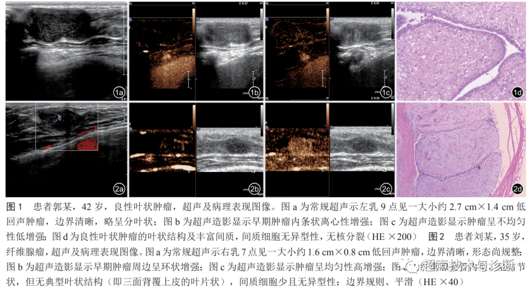 乳腺叶状肿瘤的超声表现.